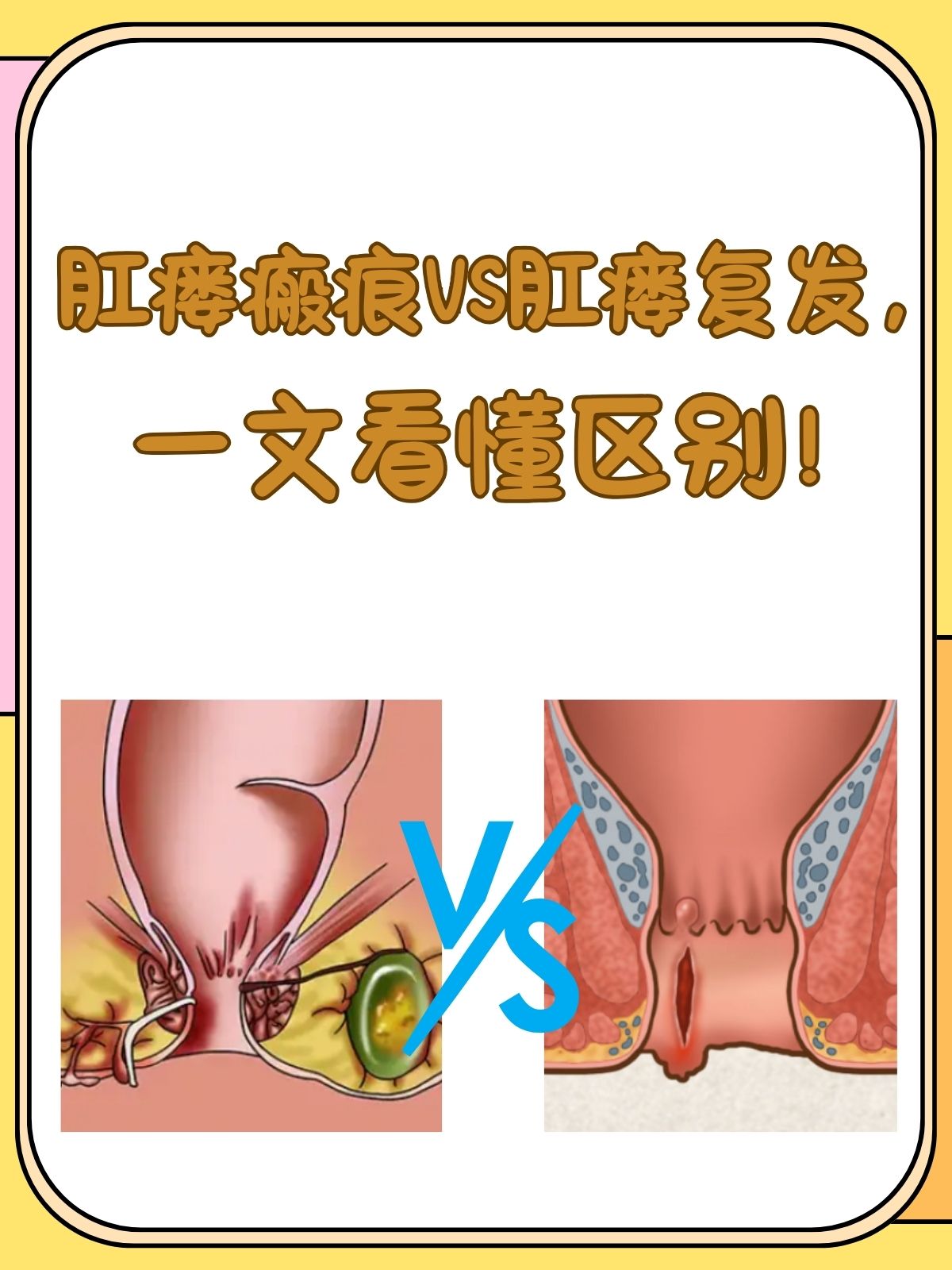 肛瘘会癌变吗