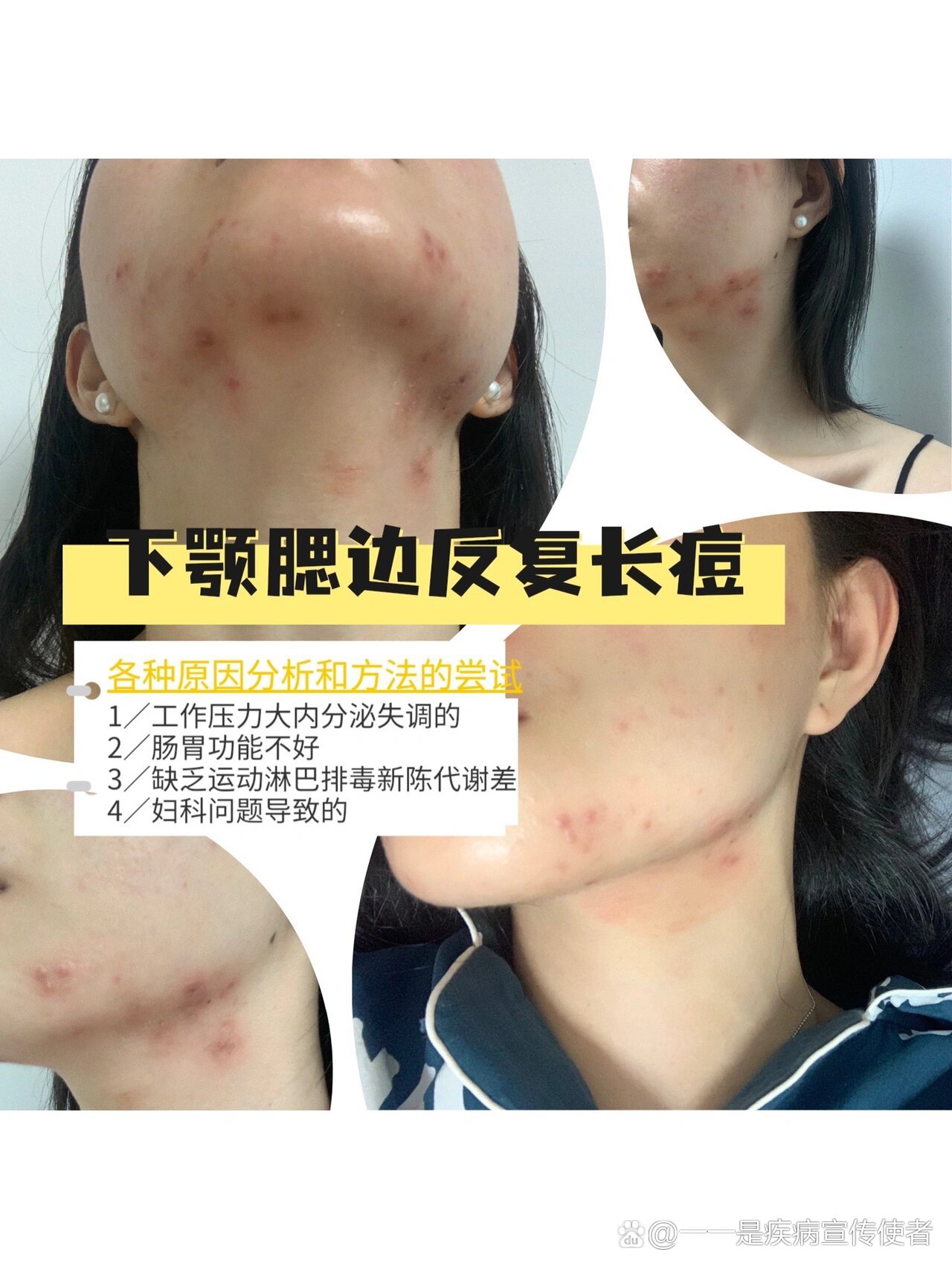 腮帮子肉里长个疙瘩是什么