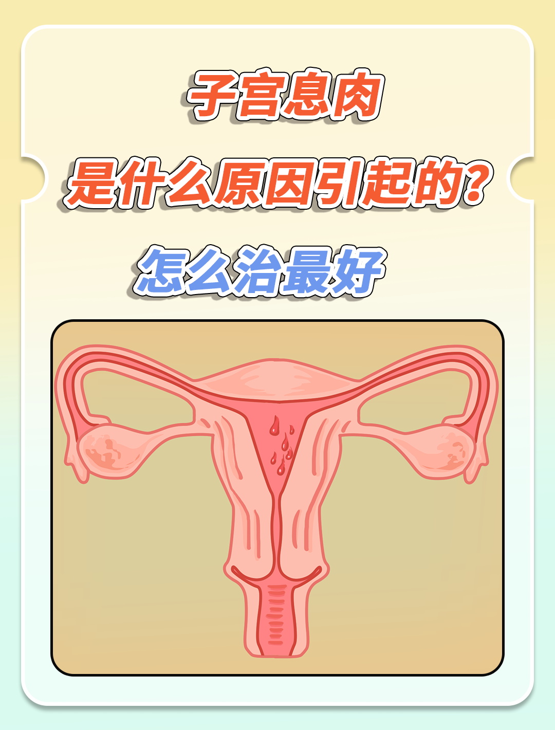 什么是子宫内膜息肉