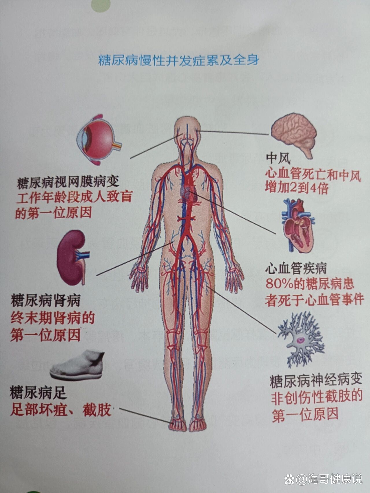 糖尿病并发症的症状
