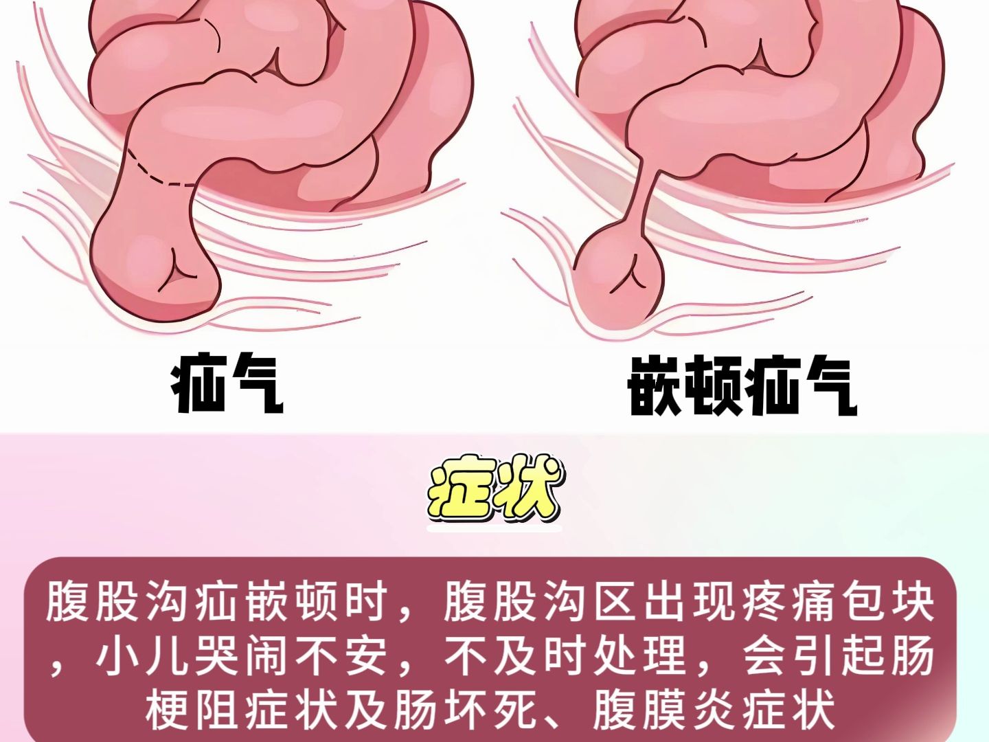 疝气的症状有几种