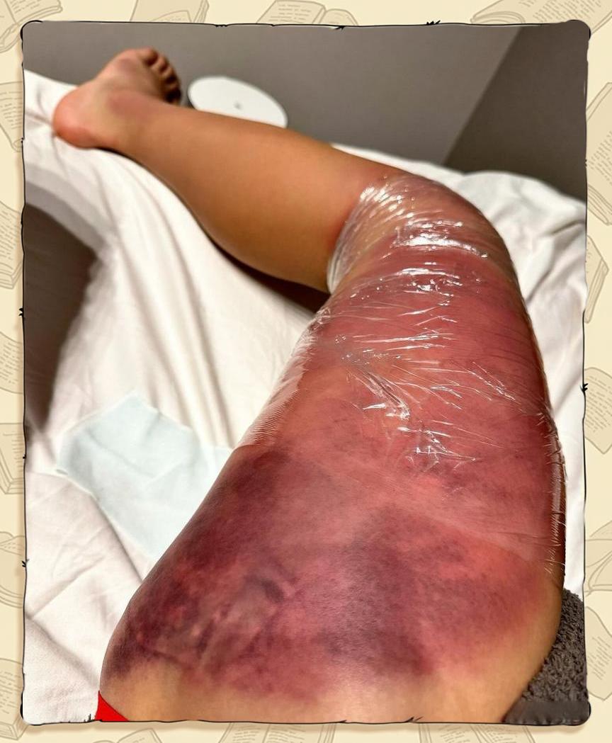 大腿肌肉拉伤怎么治疗?