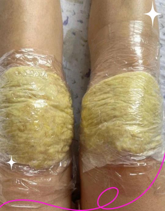 滑膜炎严重了会瘫痪吗