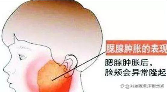 流行性腮腺炎的传播途径