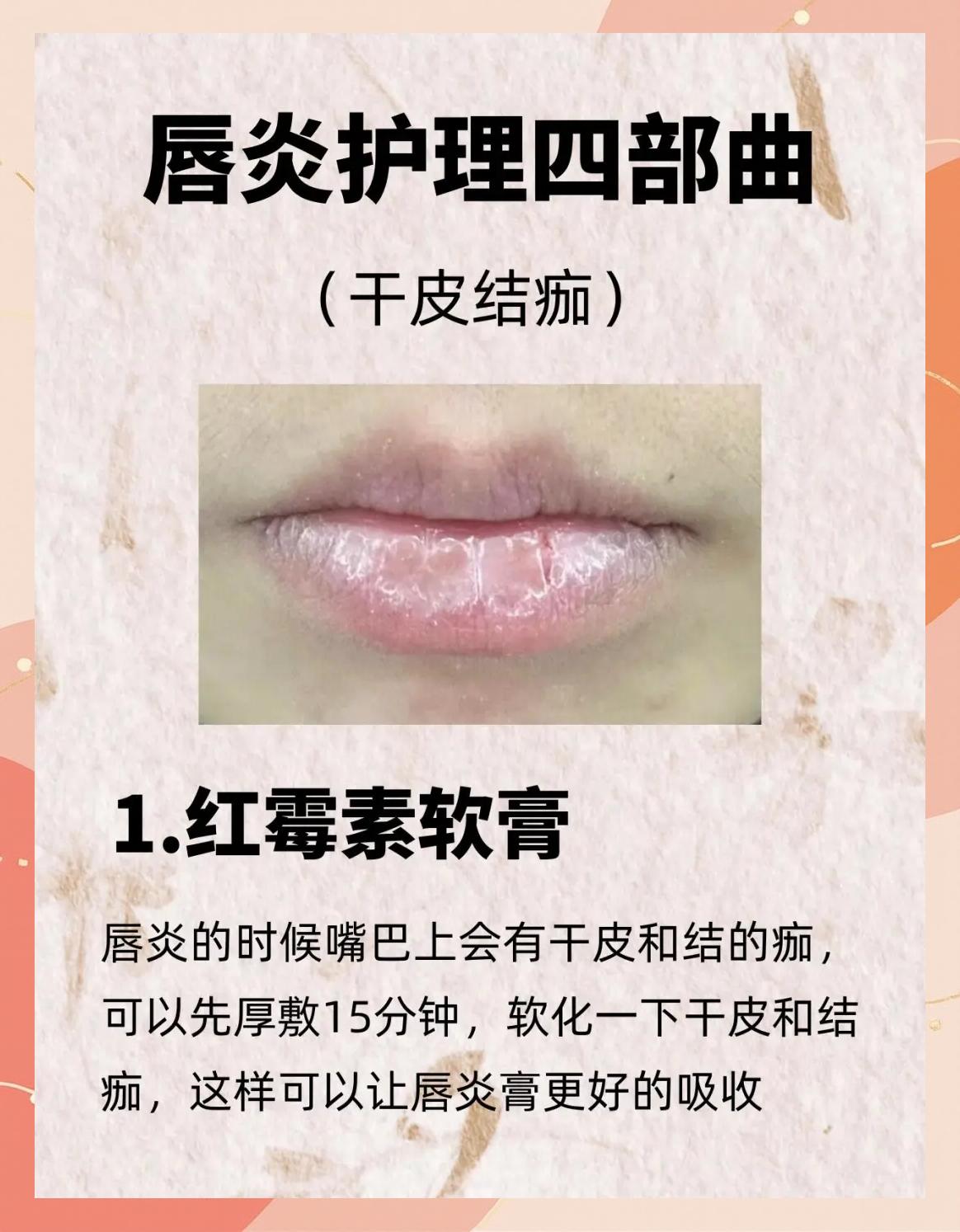 唇炎能治好吗