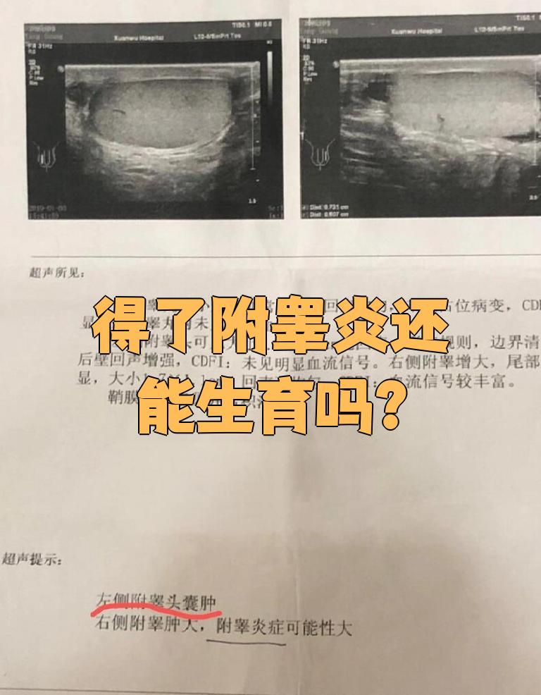 得了附睾炎严重吗?