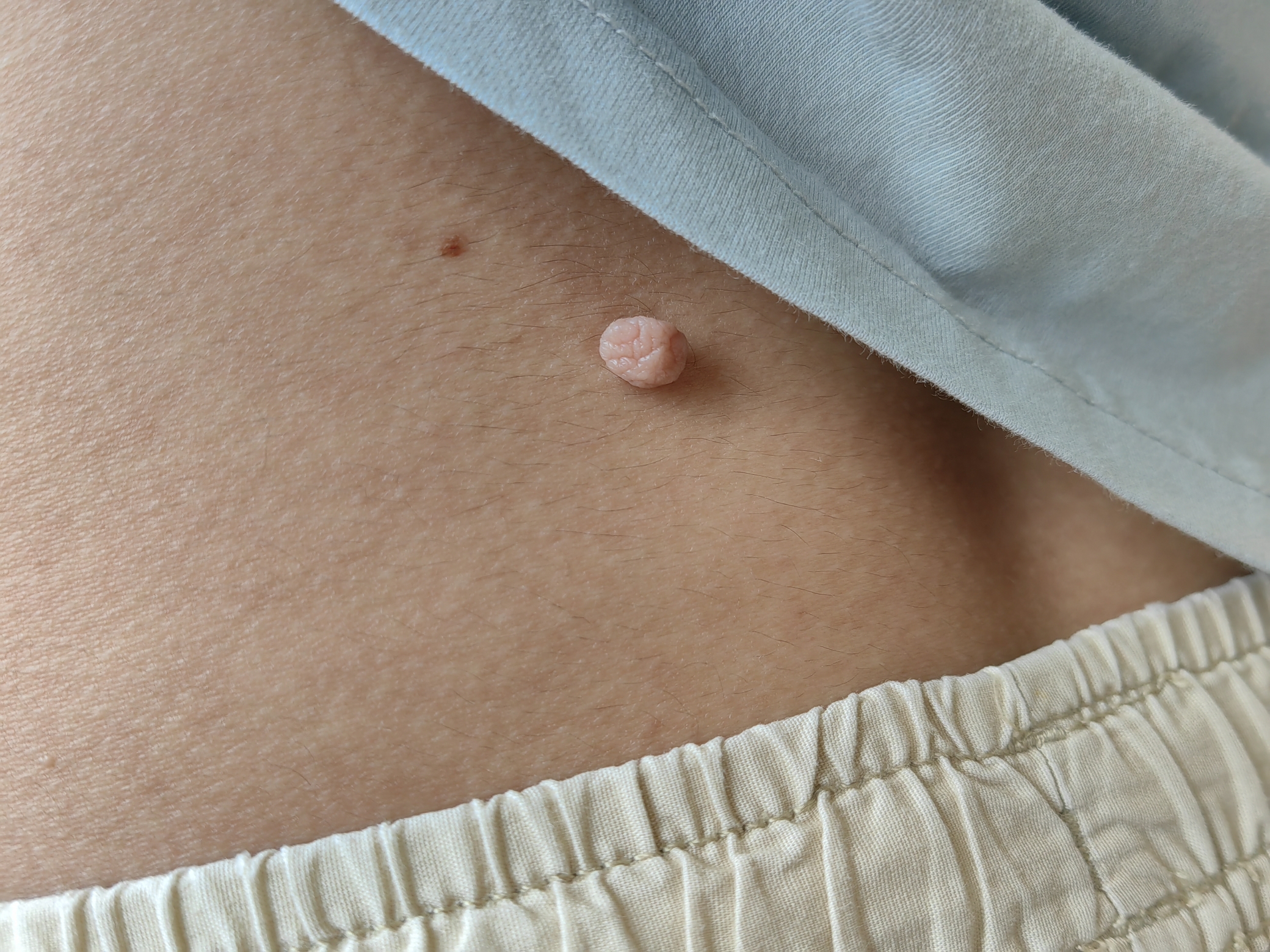 肉里面突然长了个硬疙瘩