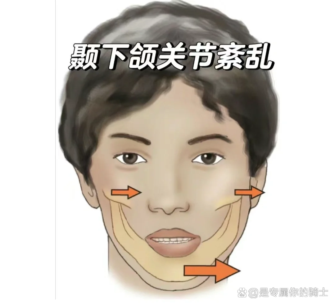颞下颌关节紊乱症会自愈吗