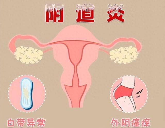 霉菌性阴道炎怎么引起