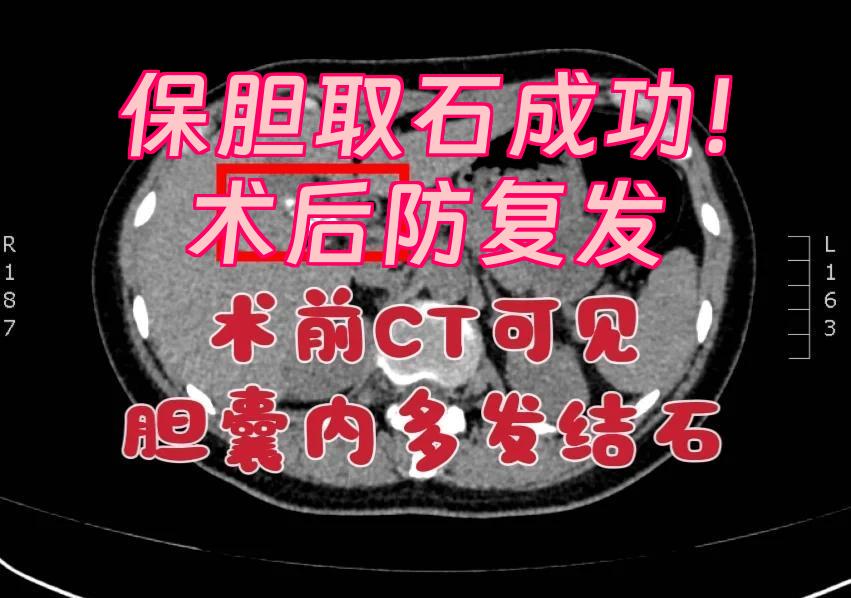 保胆取石手术费用大概要多少