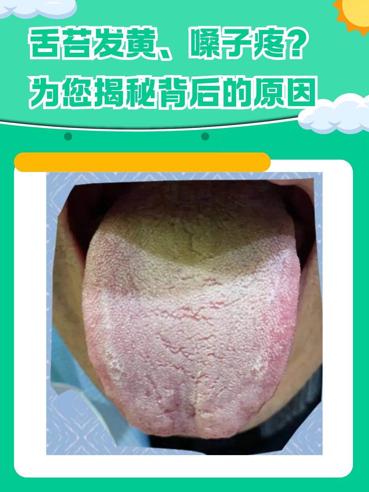 舌苔厚白是怎么回事?