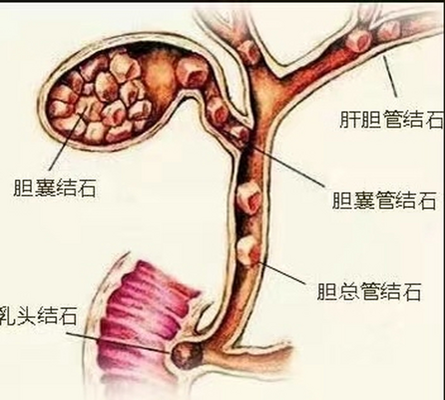 胆管结石症状表现