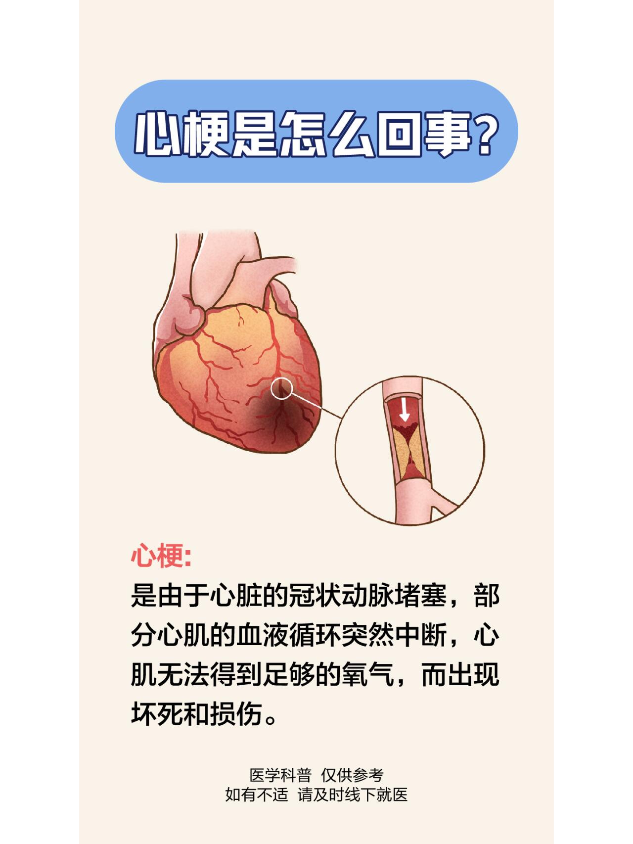 轻度心梗症状有哪些