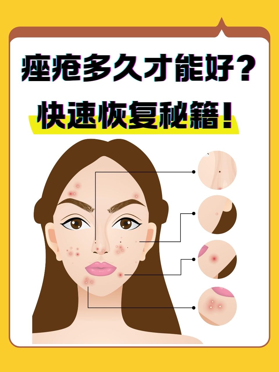 去除痤疮的方法有哪些