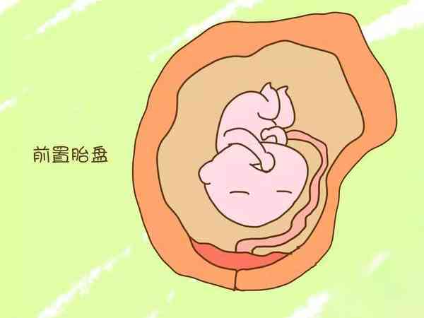 胎盘前置是什么