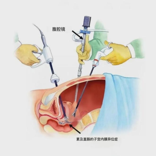 巧克力囊肿怎么治疗?
