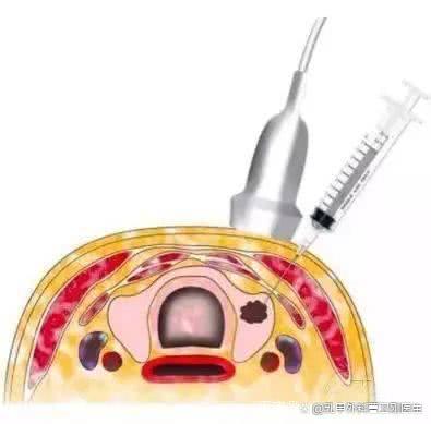 什么是甲状腺穿刺术