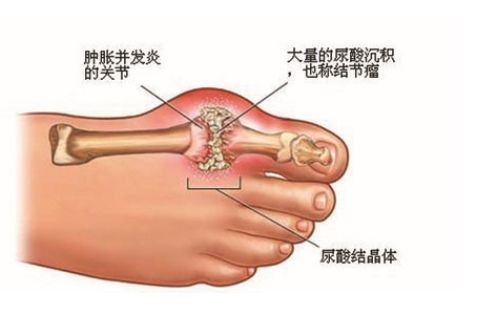 尿酸高可以喝酸奶吗