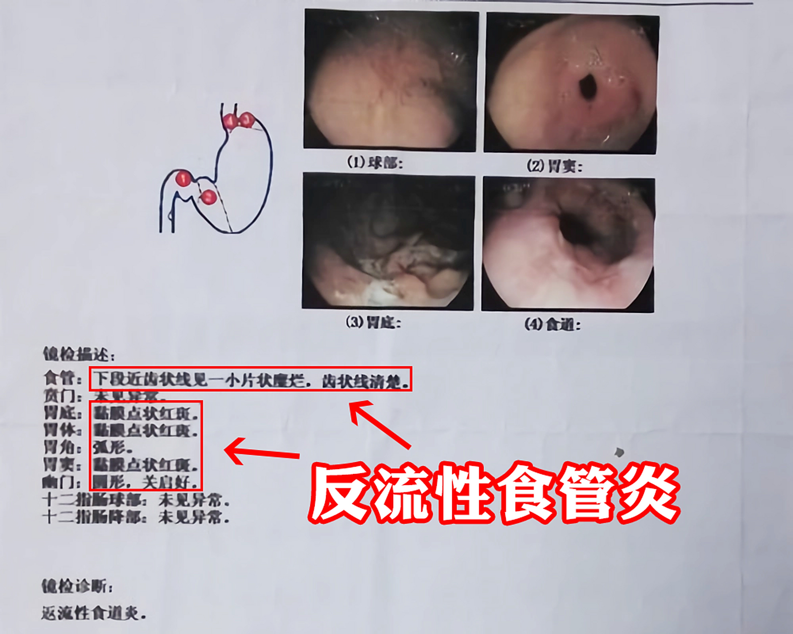 反流性食管炎症状有哪些