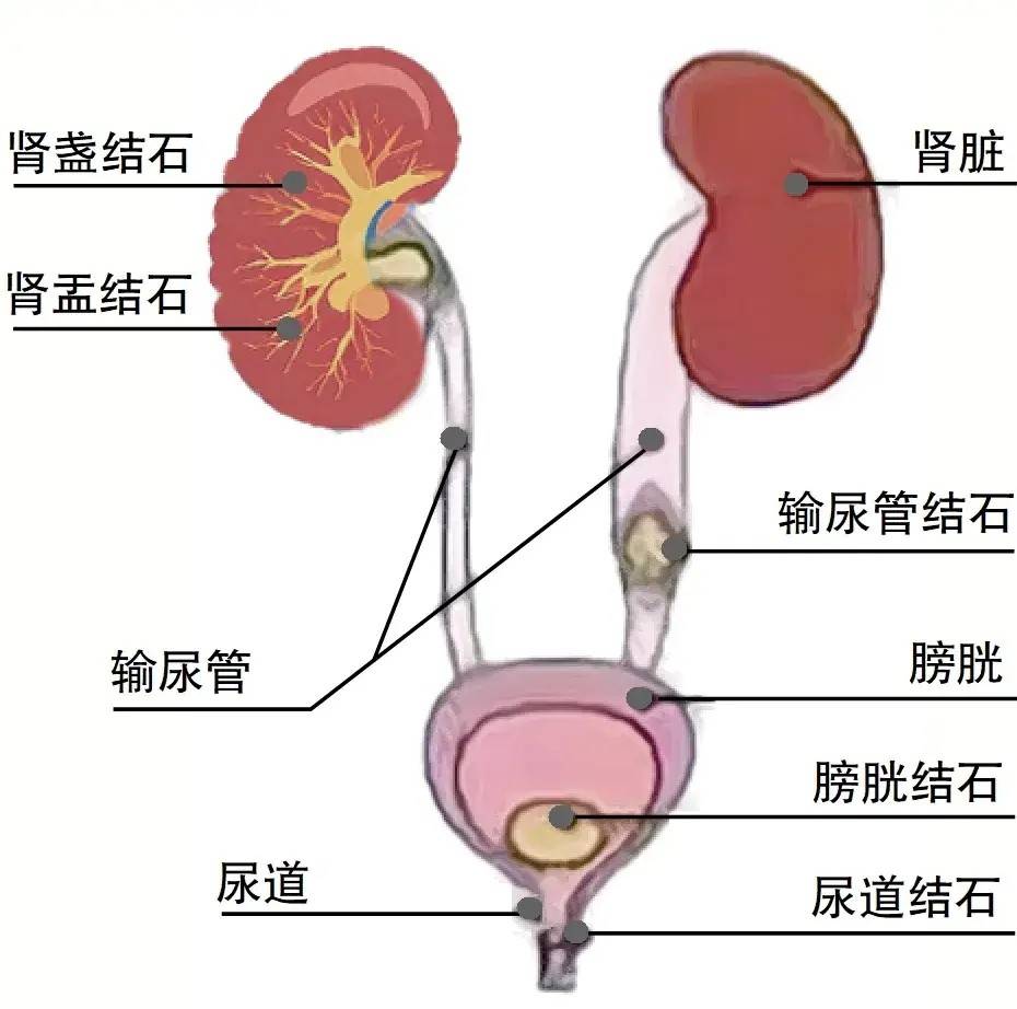结石痛怎么快速止痛?