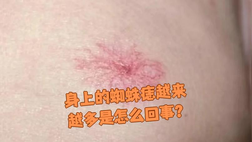 有蜘蛛痣一定是肝炎吗