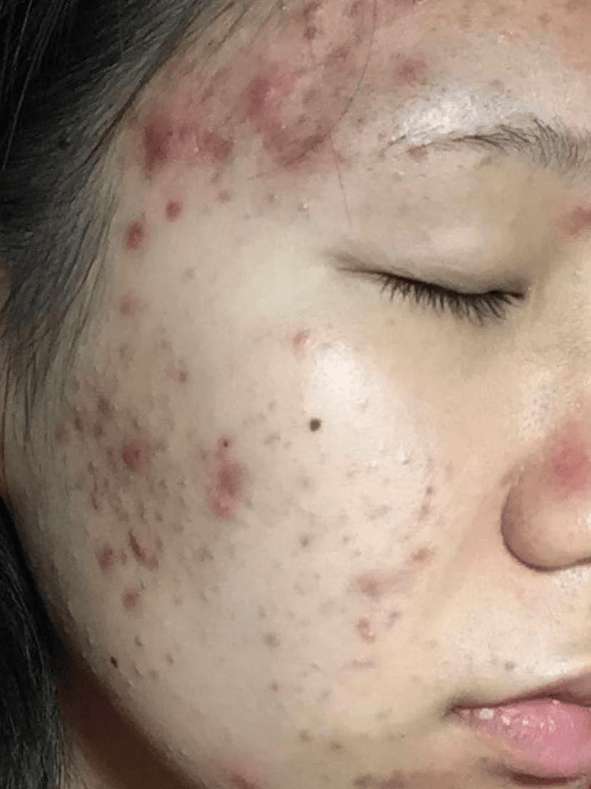 满脸长痘痘怎么办