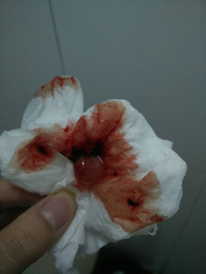 药流排出的孕囊什么样