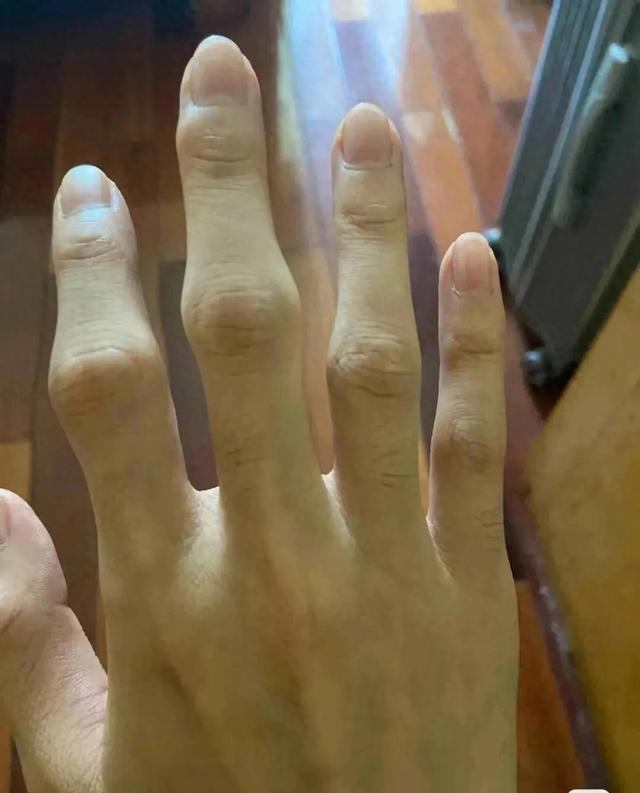 类风湿病症状有哪些