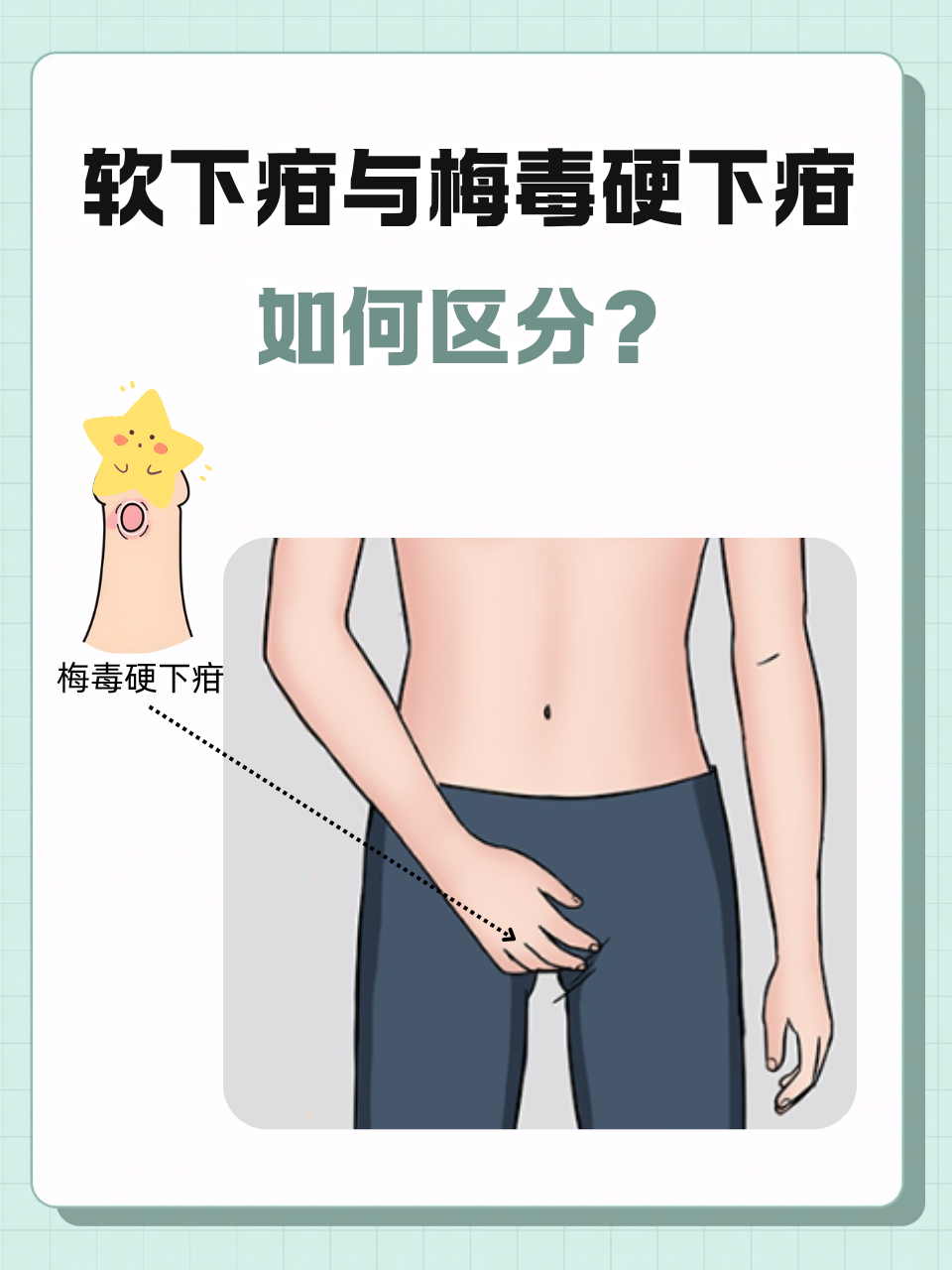 软下疳常见的症状有哪些?