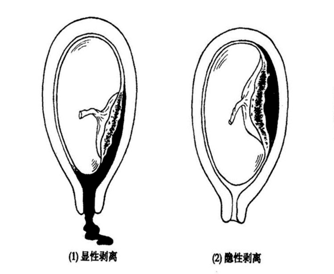 胎盘早剥的前期征兆
