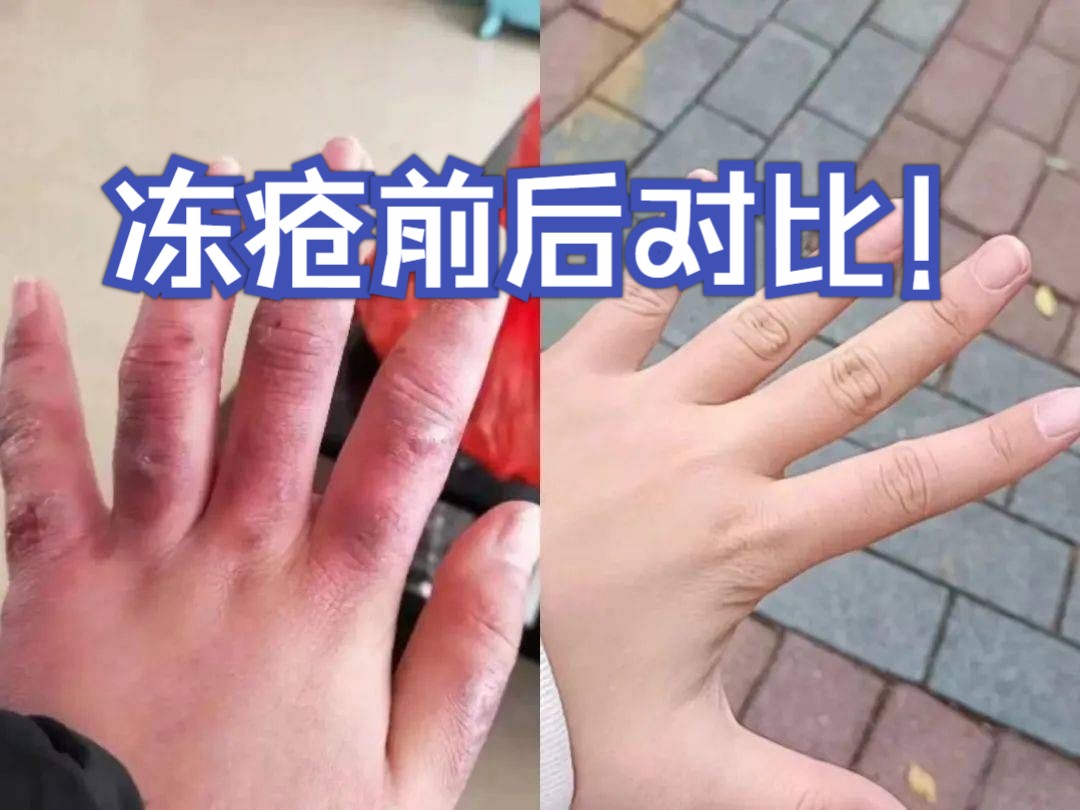 生冻疮怎么办