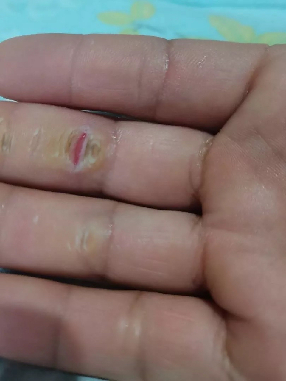 被男朋友用手指后,第二天有种被撑开的感觉这是为什么