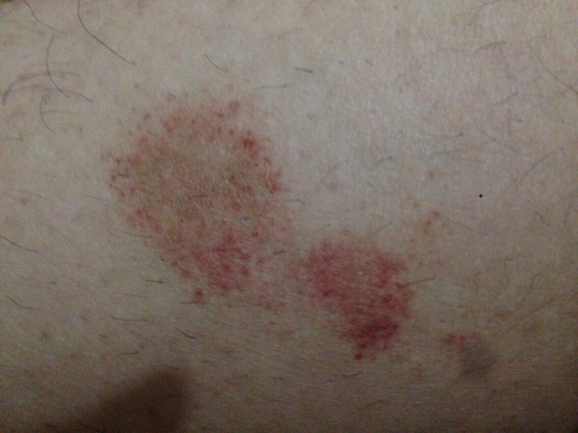 腿上有红斑,经常会痒,实际情况下面附有图片.