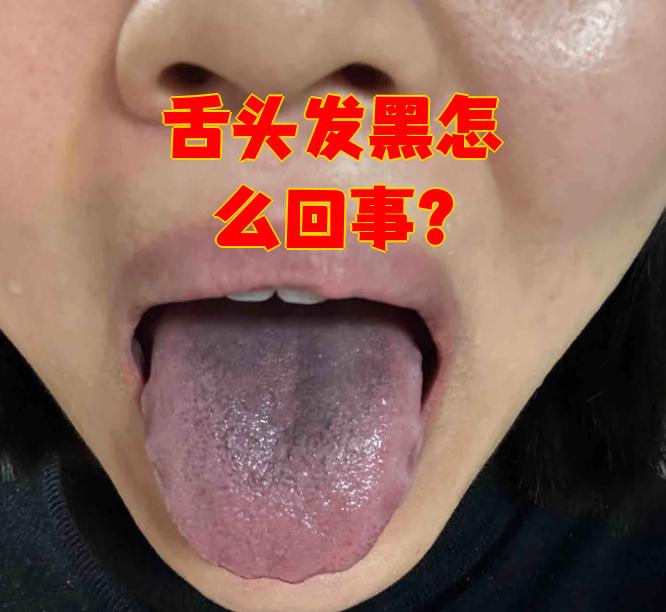 舌苔发黑怎么办