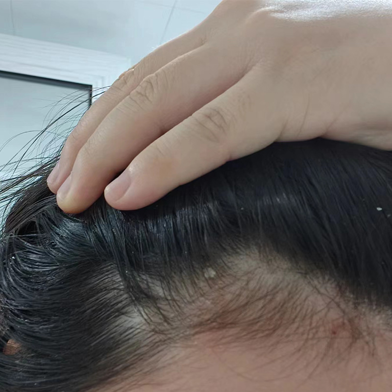 头皮上长小红疙瘩是什么原因?