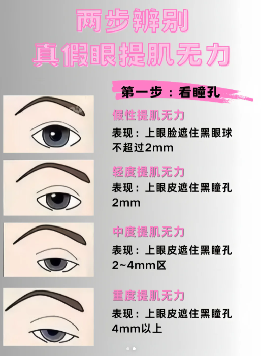 什么是眼睑肌无力