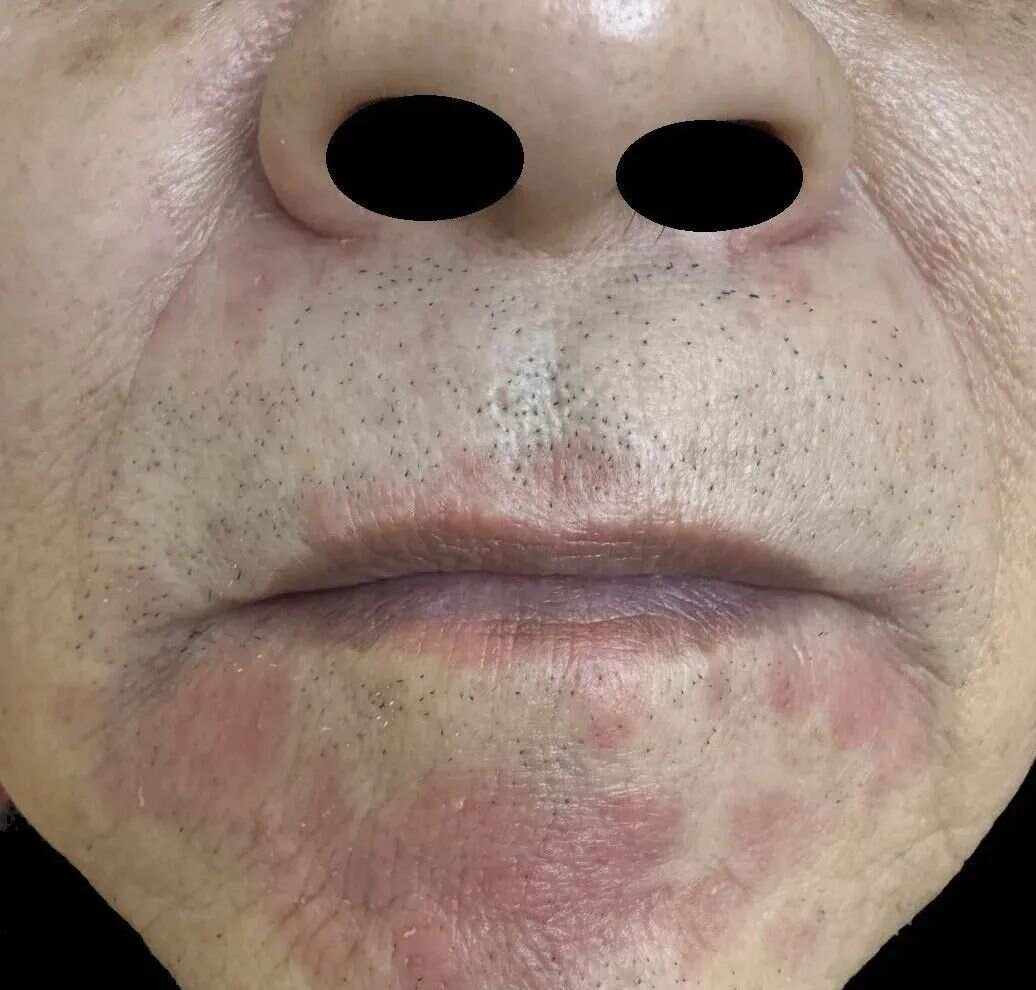 脂溢性湿疹是什么病
