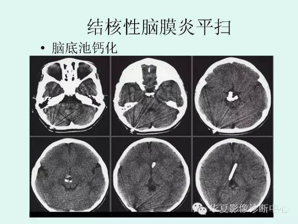 结核性脑膜炎严重吗?
