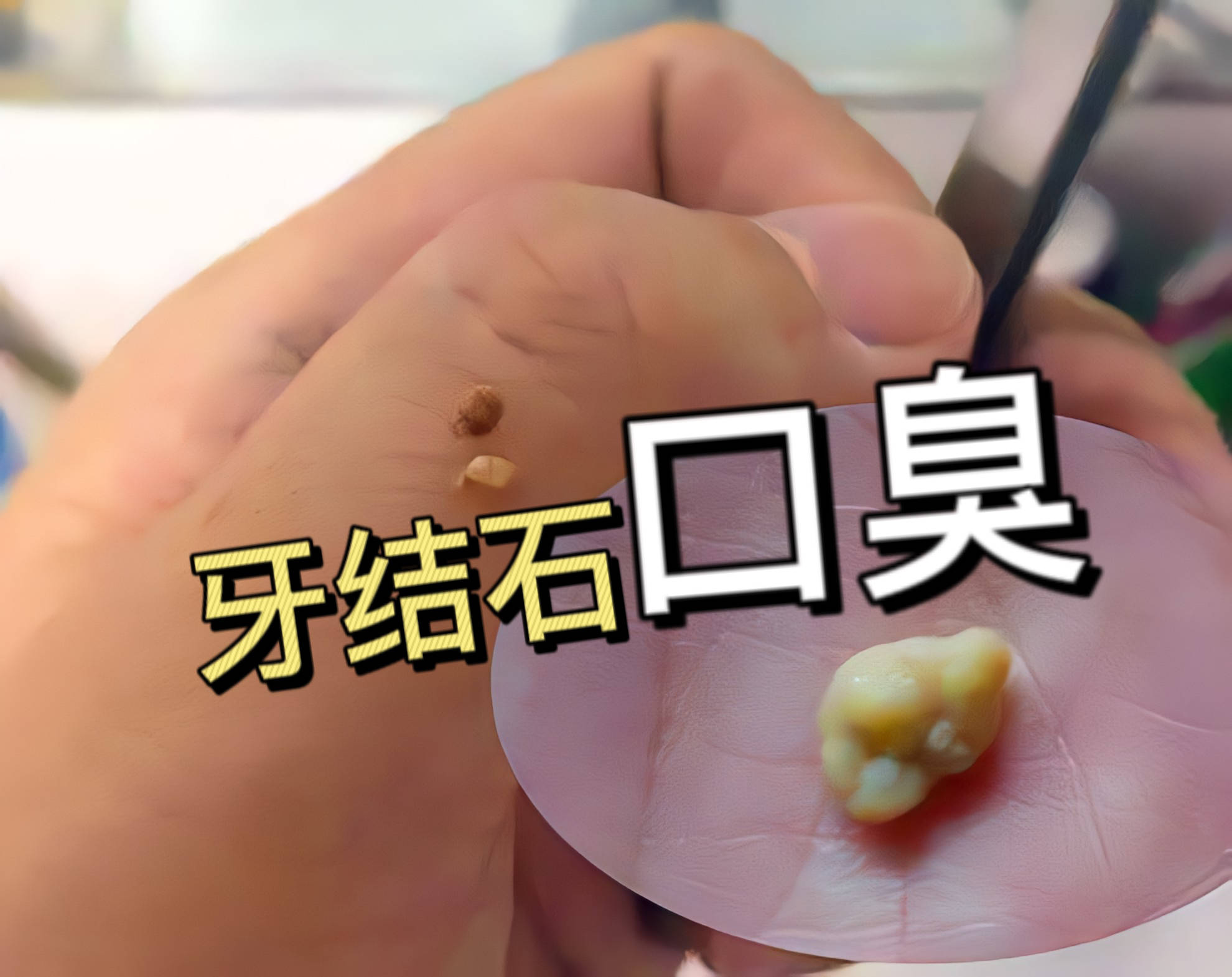 牙结石能引起口臭吗?..