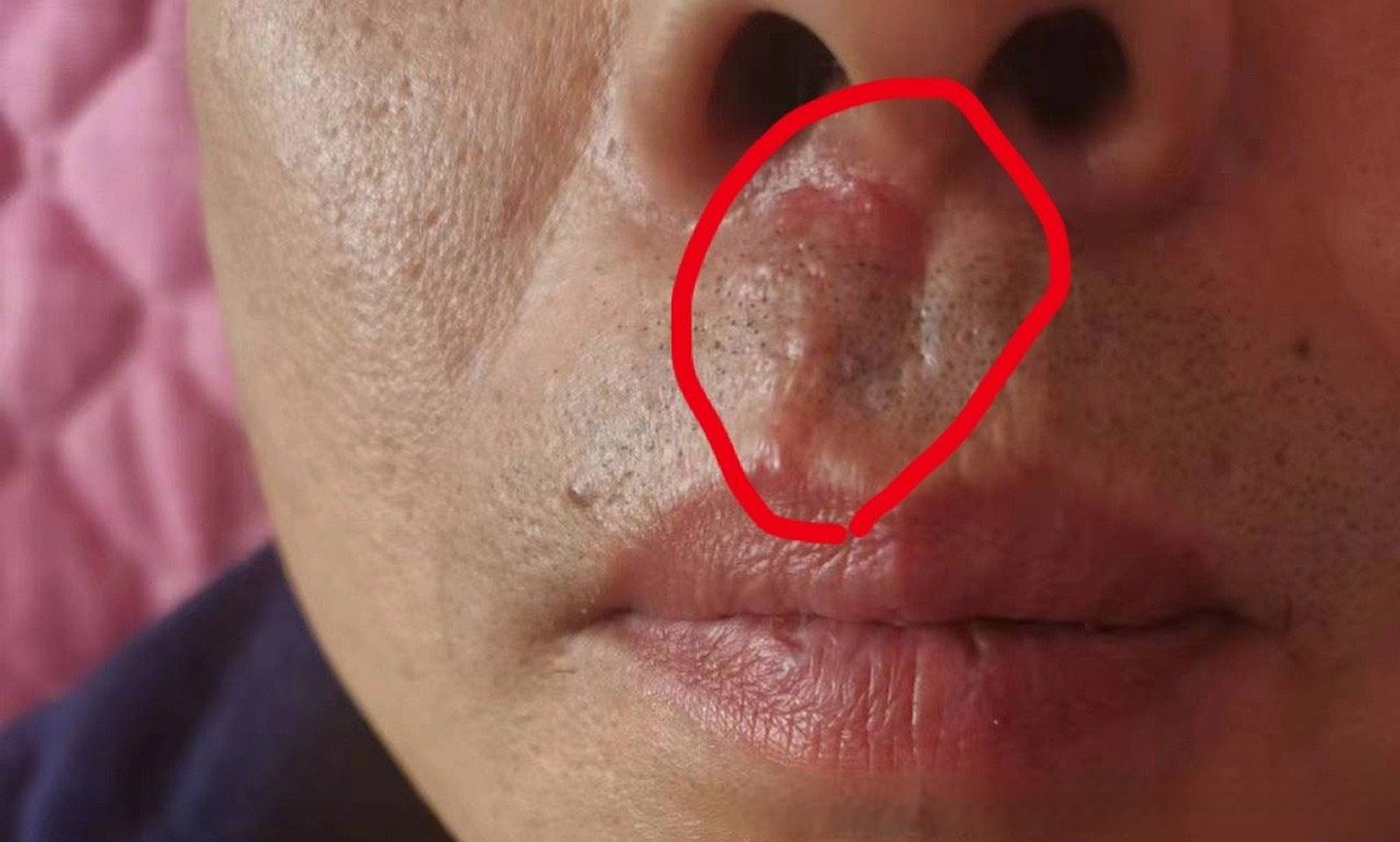 口唇疱疹症状