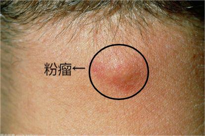 粉瘤是怎么形成的?