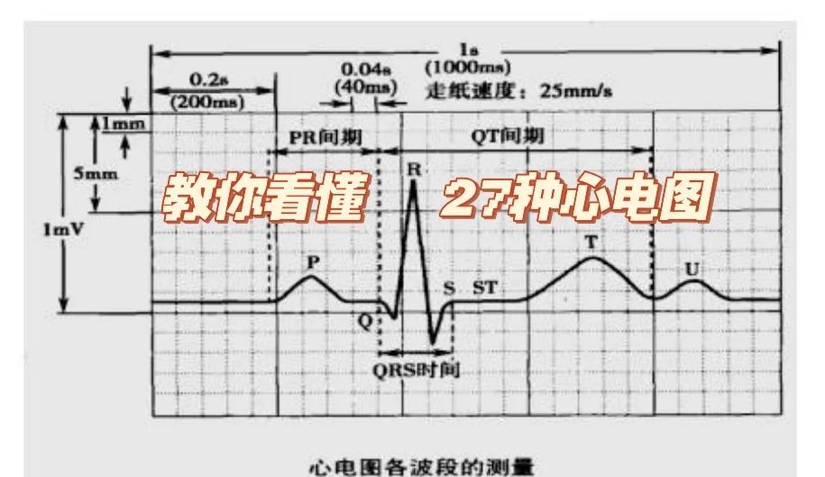 心电轴右偏是什么意思