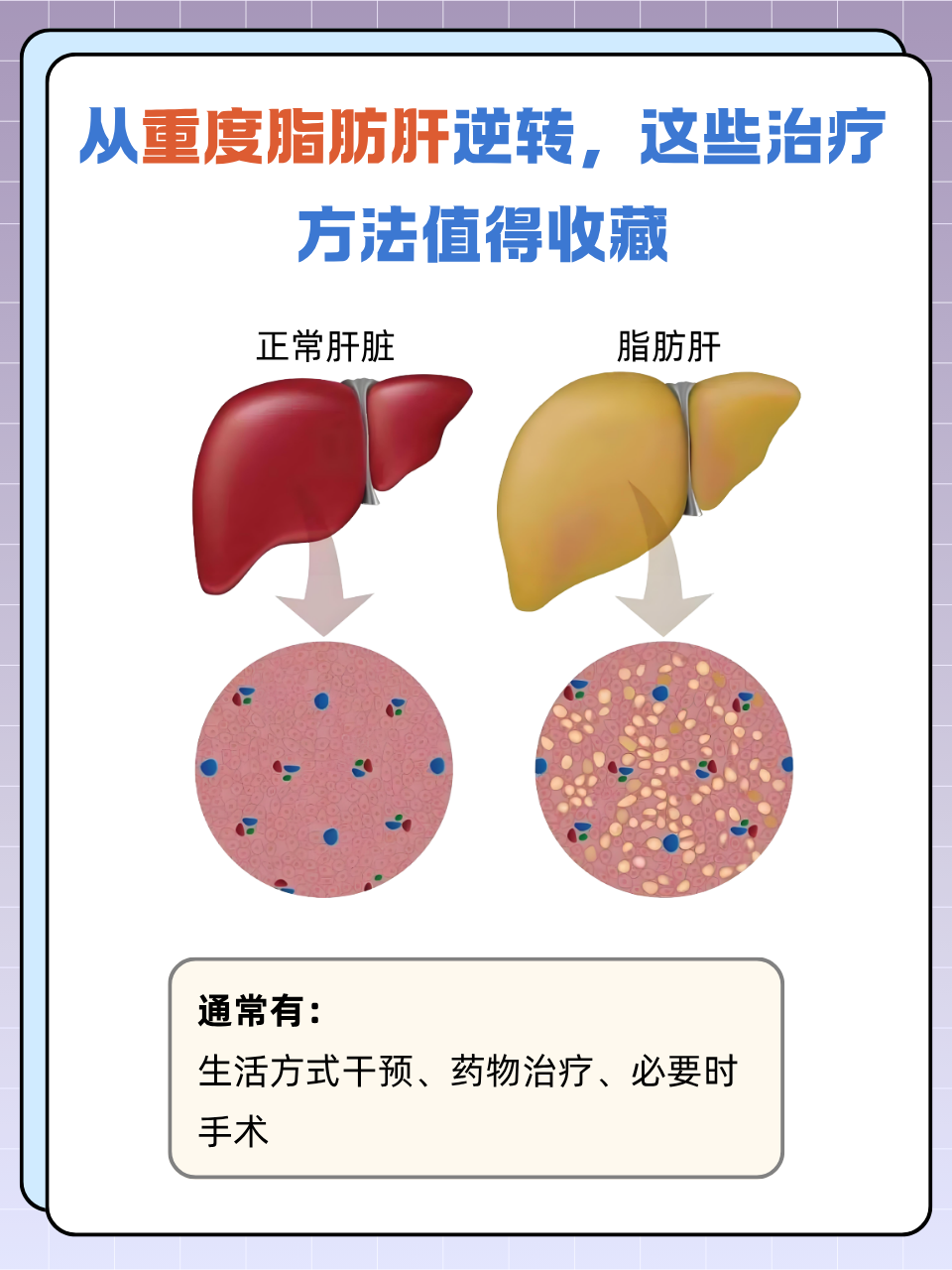 重度脂肪肝治疗方法有哪些