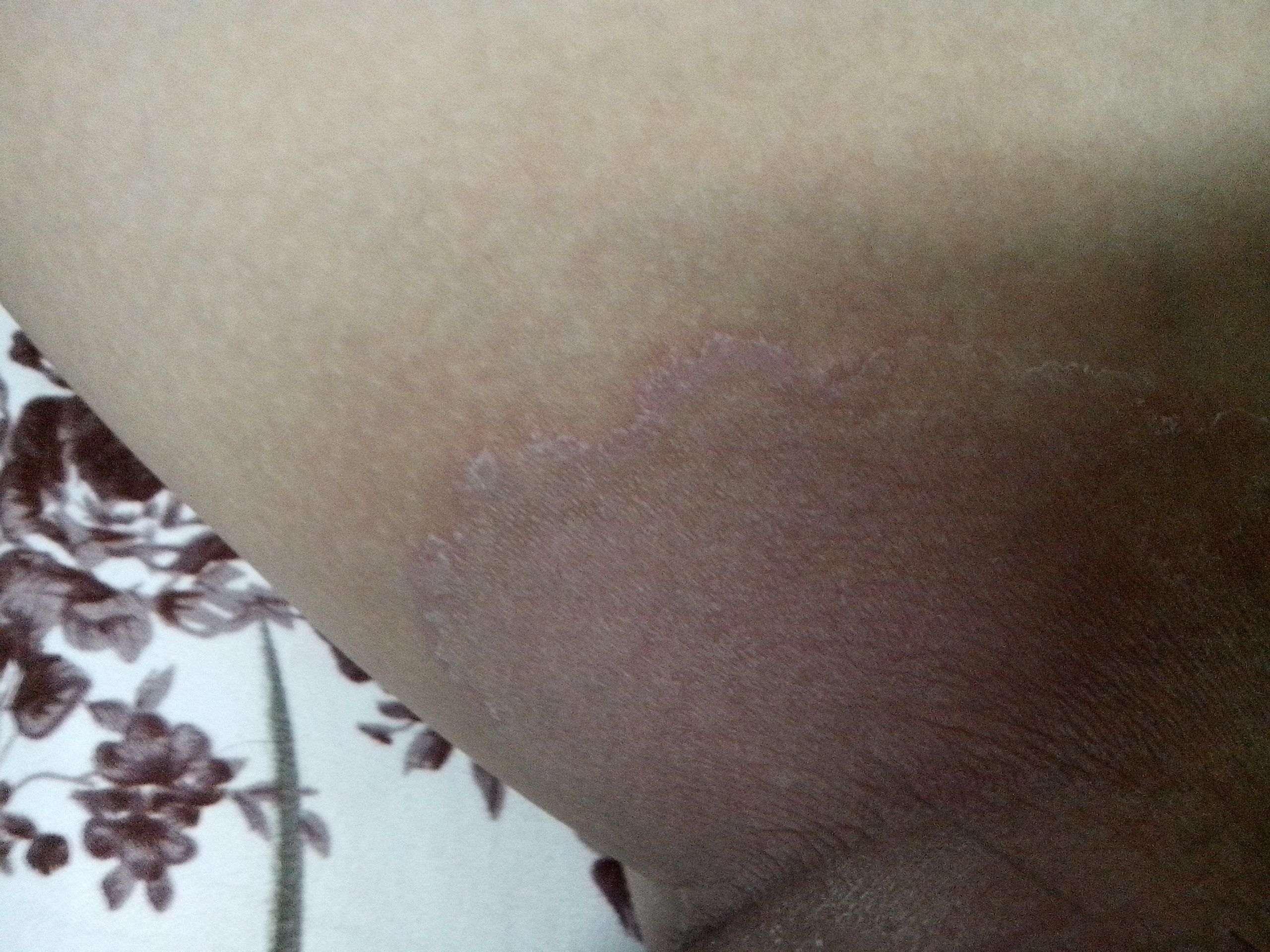 男性大腿根部湿疹图片症状表现