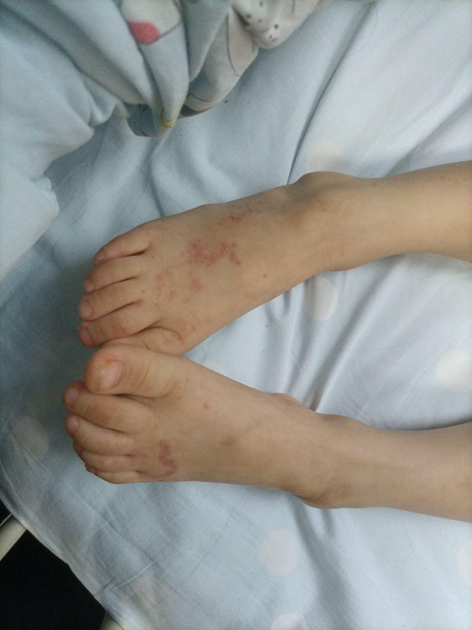 紫癜传染吗