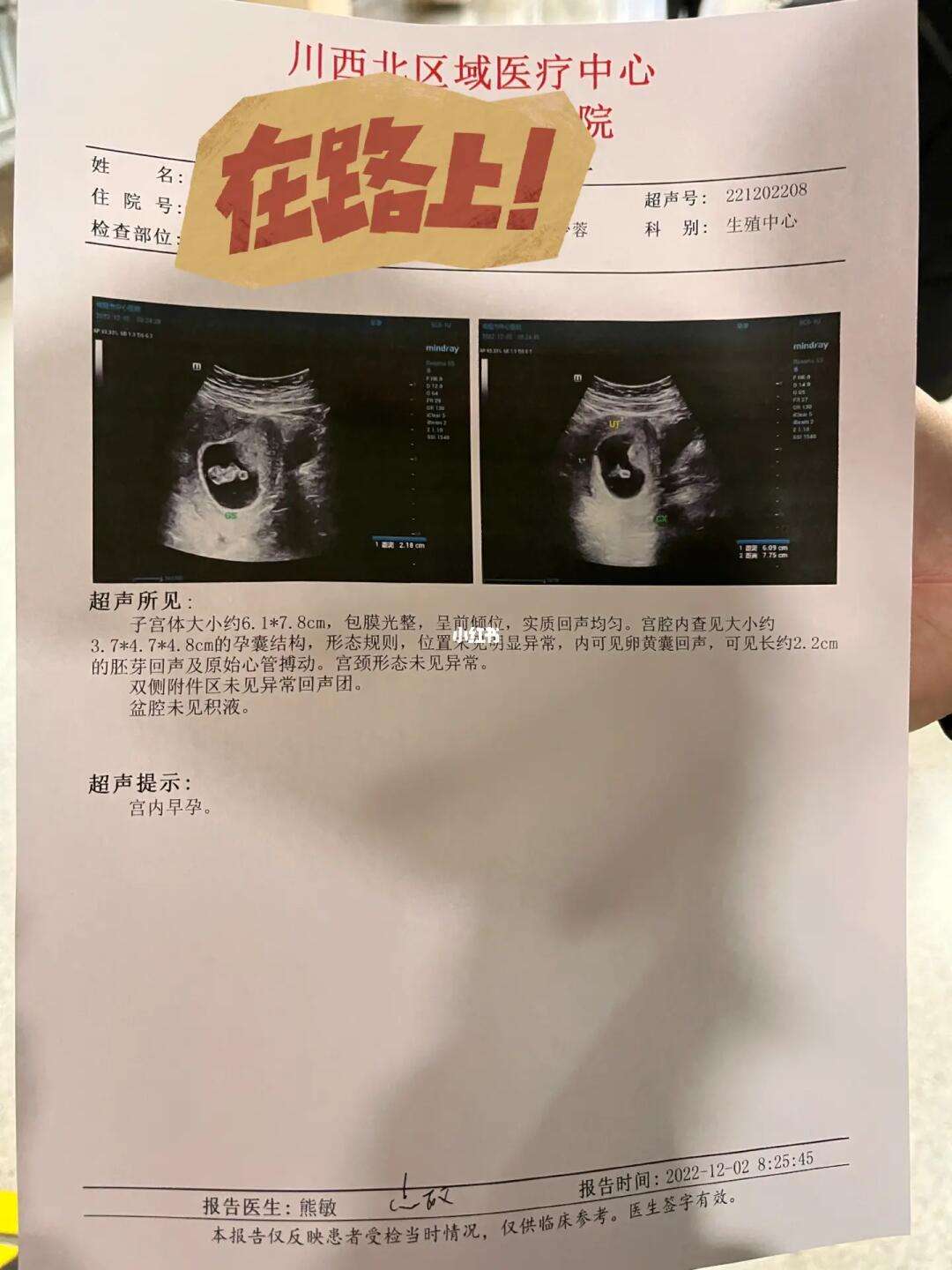 怀孕8周孕囊多大