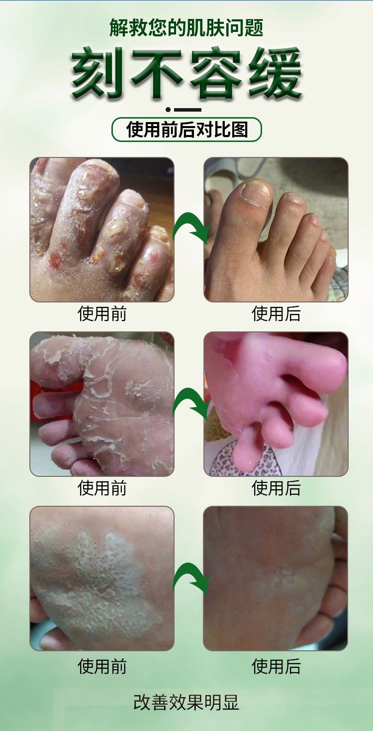 脚丫烂用什么药比较好
