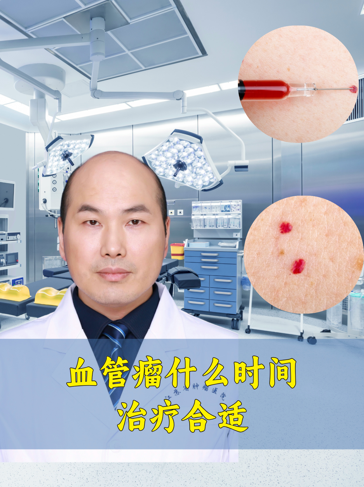 脑血管瘤的治疗方法