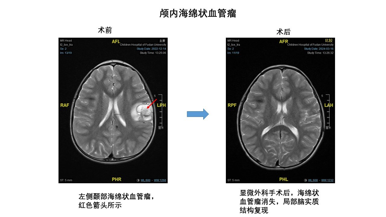 脑血管瘤的治疗方法