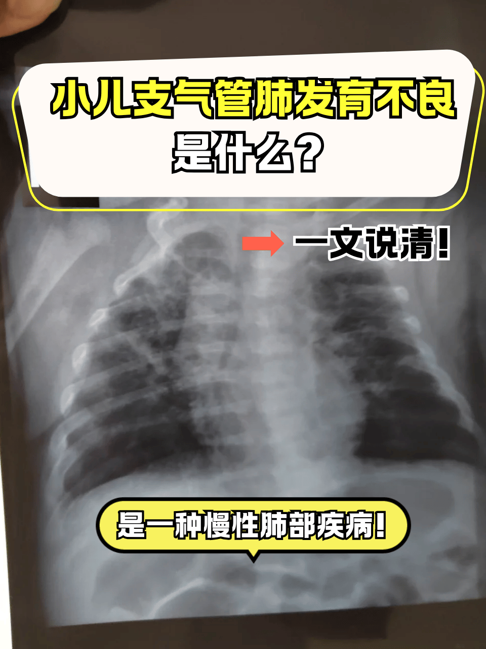 小儿肺炎严重吗